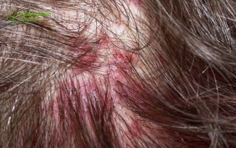 Viêm nang lông, viêm nang lông lưng - xà phòng trị viêm nang lông 3 viêm nang lông đầu